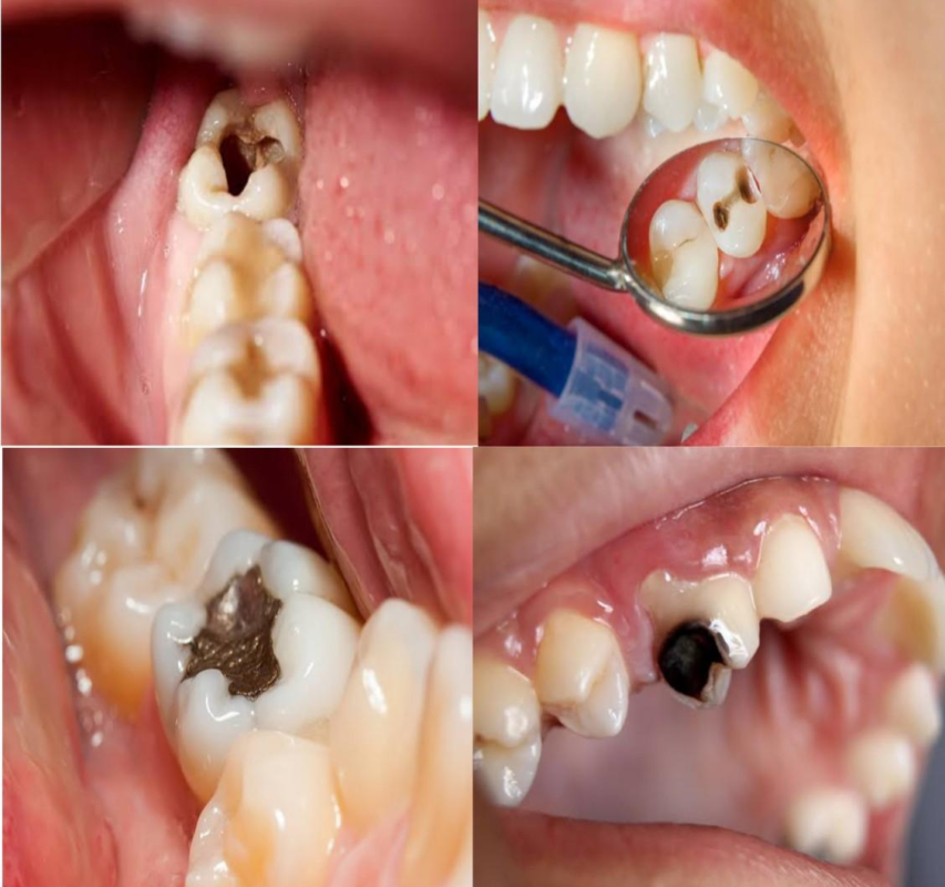 How a General Dentist Can Treat a Cavity