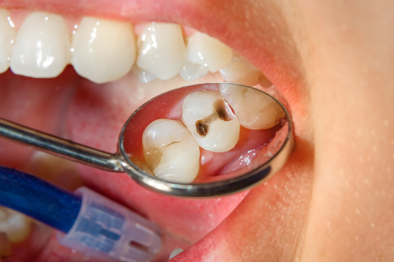 How a General Dentist Can Treat a Cavity
