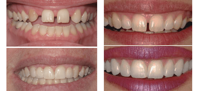 How Cosmetic Dentistry Improve Your Appearance