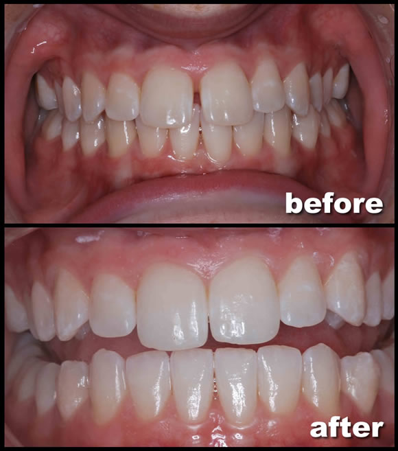 How Can Invisalign Work for Gaps